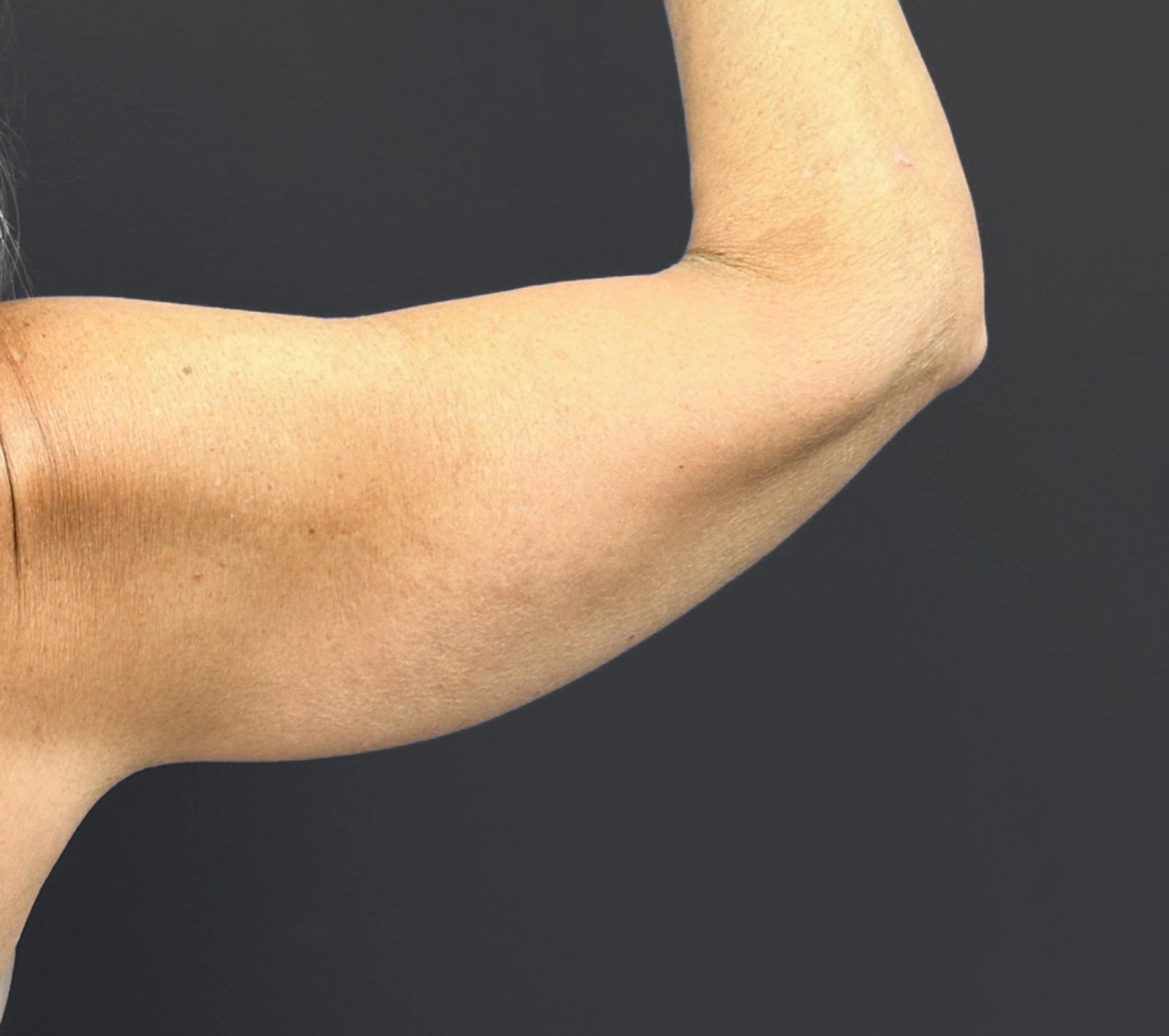 Brachioplasty-Case--6382 | After Arm Lift 3