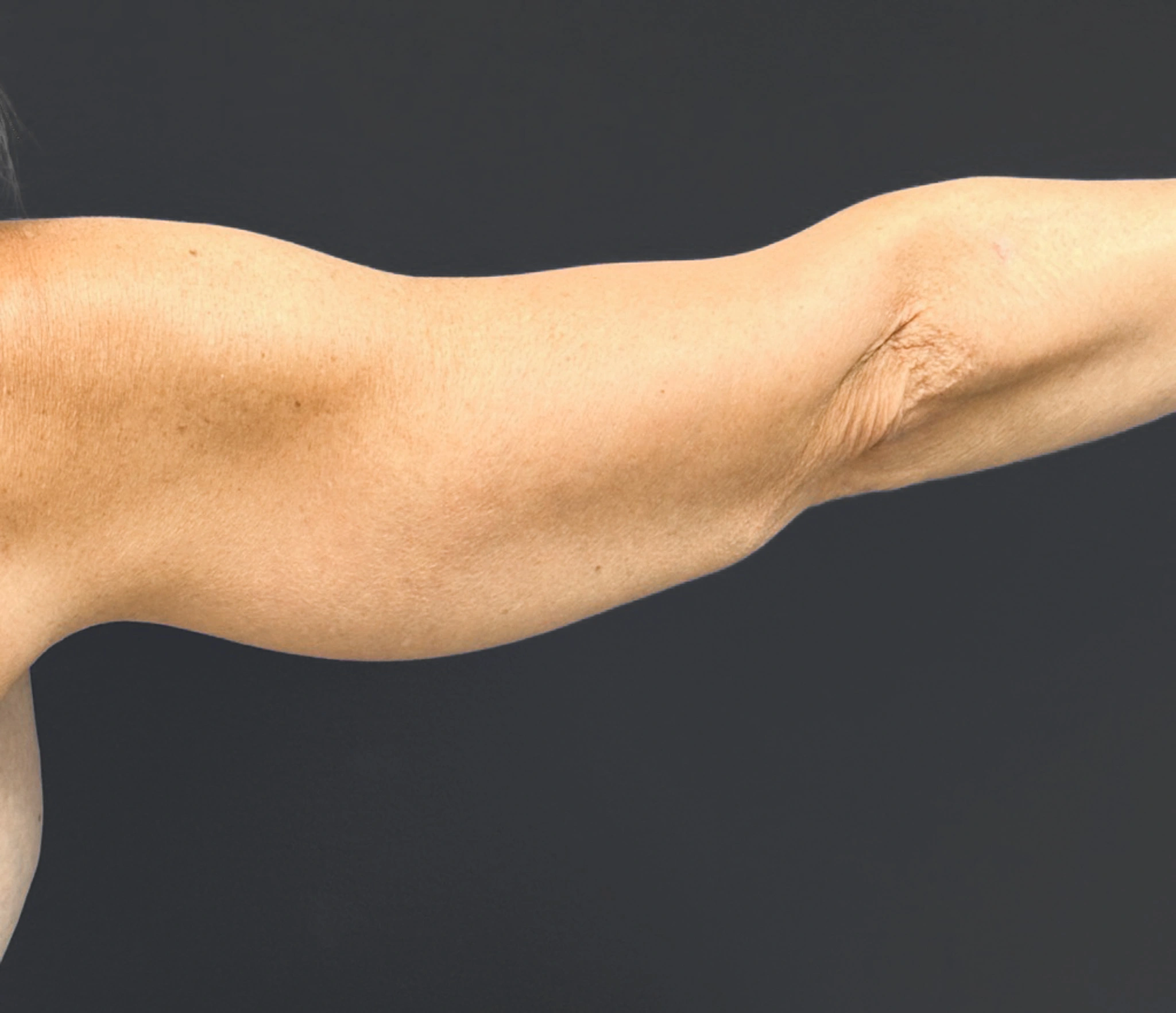 Brachioplasty-Case--6382 | After Arm Lift 1