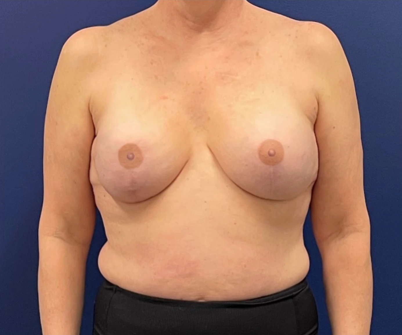 Breast-Reconstruction-Case--308 | After Breast Reconstruction 1