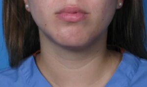 Case--293 | After Submental Liposuction 1