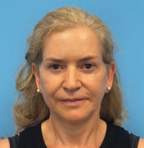 Facelift-Case--292 | After Facelift 1