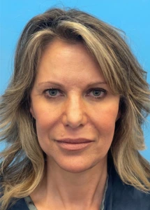 Facelift-Case--18078 | After Facelift 1