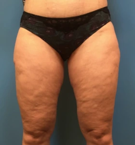 Case--281 | After Liposuction 1