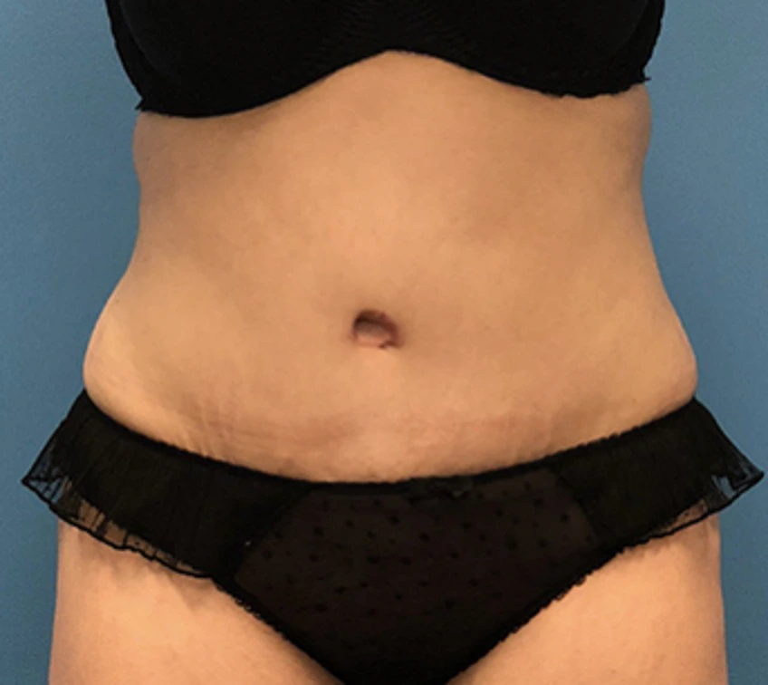 Case--56 | After Liposuction 1