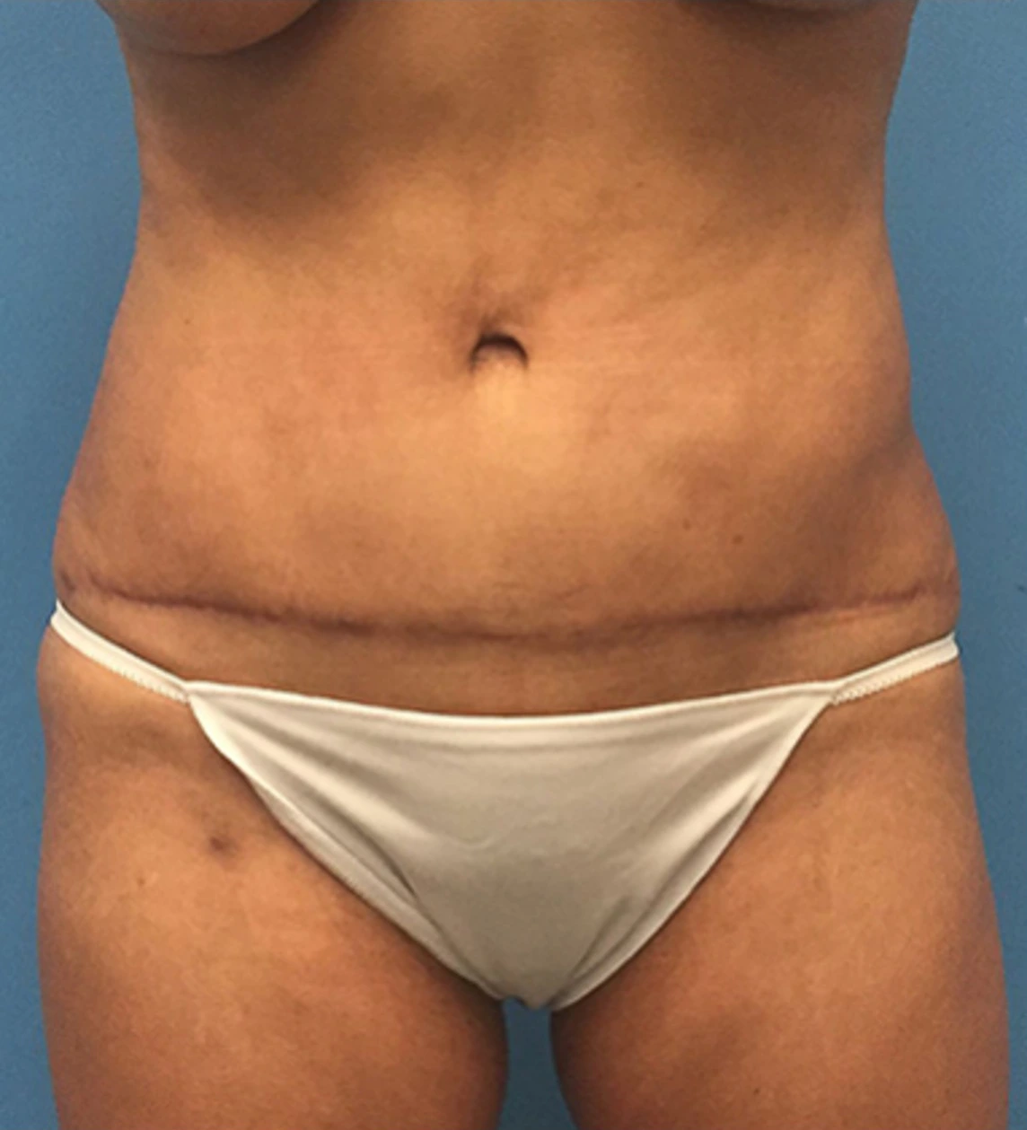 Case--65 | After Liposuction 1