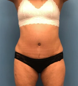 Case--14819 | After Liposuction 1