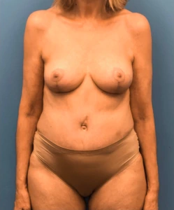 Case--17297 | After Liposuction 1