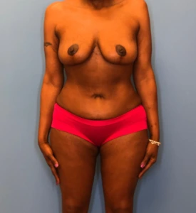 Mommy-Makeover-Case--13869 | After Mommy Makeover 1