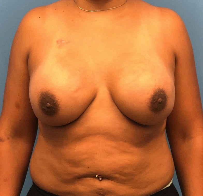 Case--11132 | After Breast Reconstruction 1