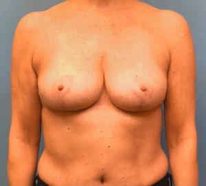 Breast-Reduction-Case--13839 | After Breast Reduction 1