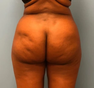 Brazilian-Butt-Lift-Case--13244 | After Brazilian Butt Lift 1