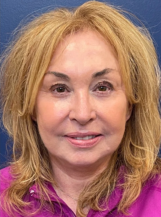 Facelift-Case--22860 | After Facelift 1