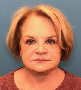 Facelift-Case--14460 | After Dr. Samir Rao 1