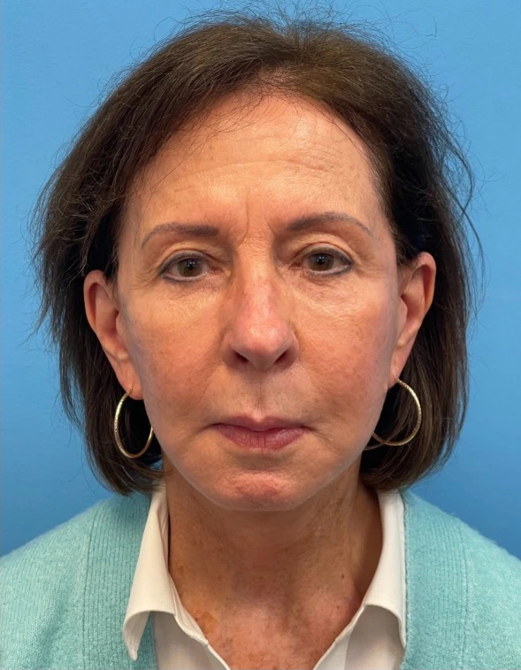 Facelift-Case--25941 | After Facelift 1