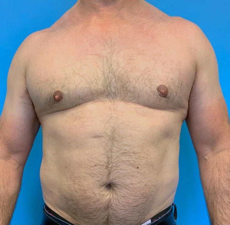 Gynecomastia-Case--20376 | After Gynecomastia / Male Breast Reduction 1