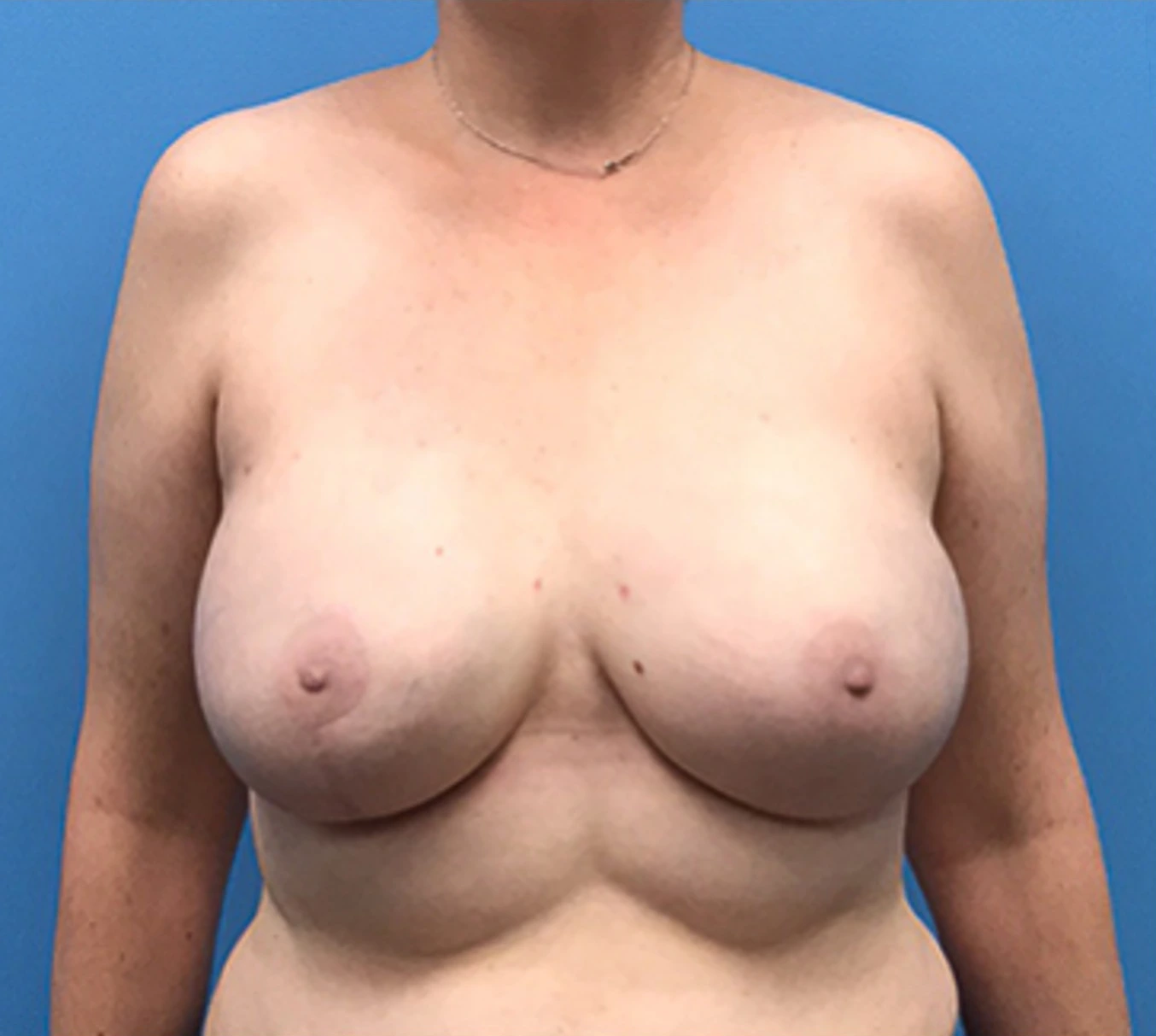 Case--135 | After Breast Reconstruction 1