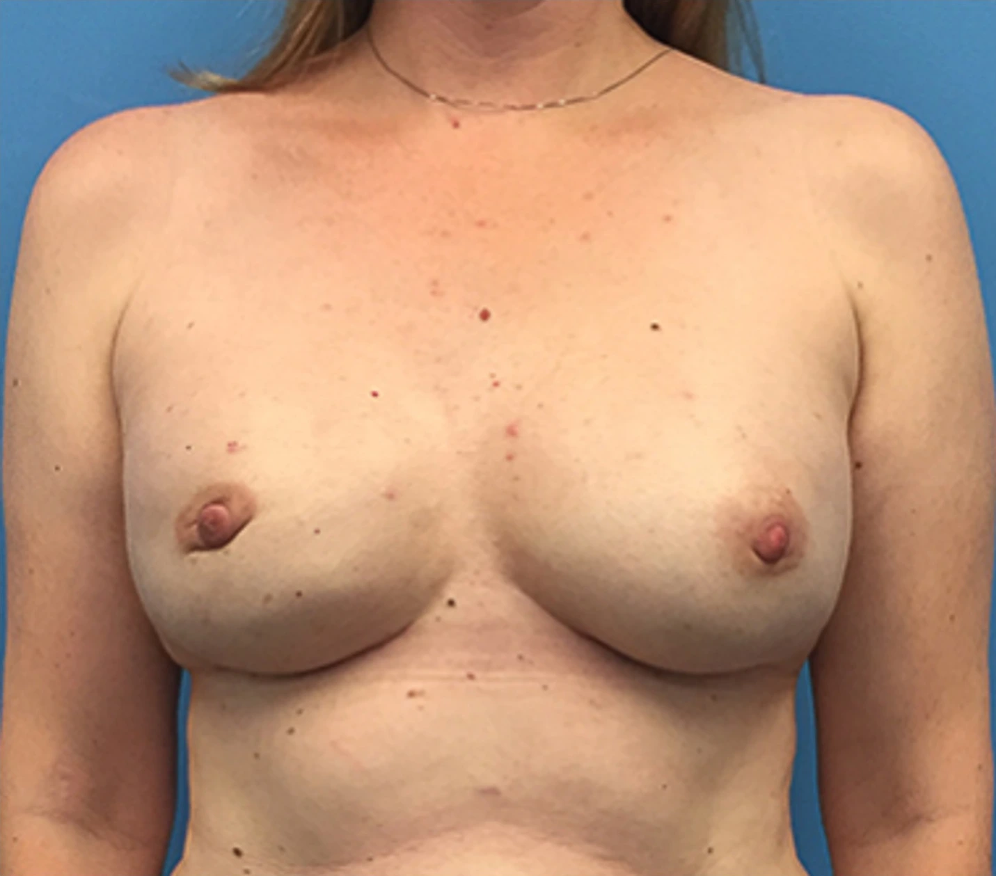 Case--138 | After Breast Reconstruction 1
