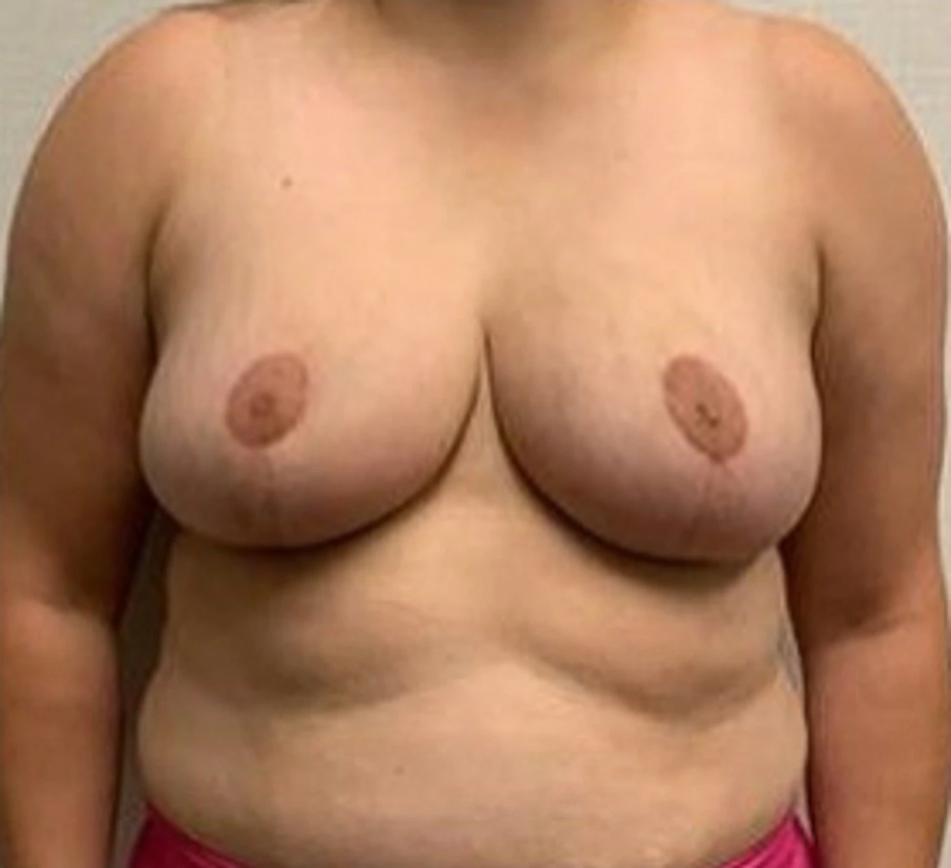 Breast-Reconstruction-Case--26525 | After Breast Reconstruction 1