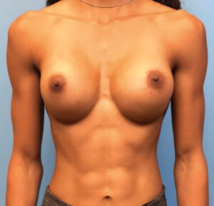 Breast-Augmentation-Case--221 | After Breast Augmentation 1