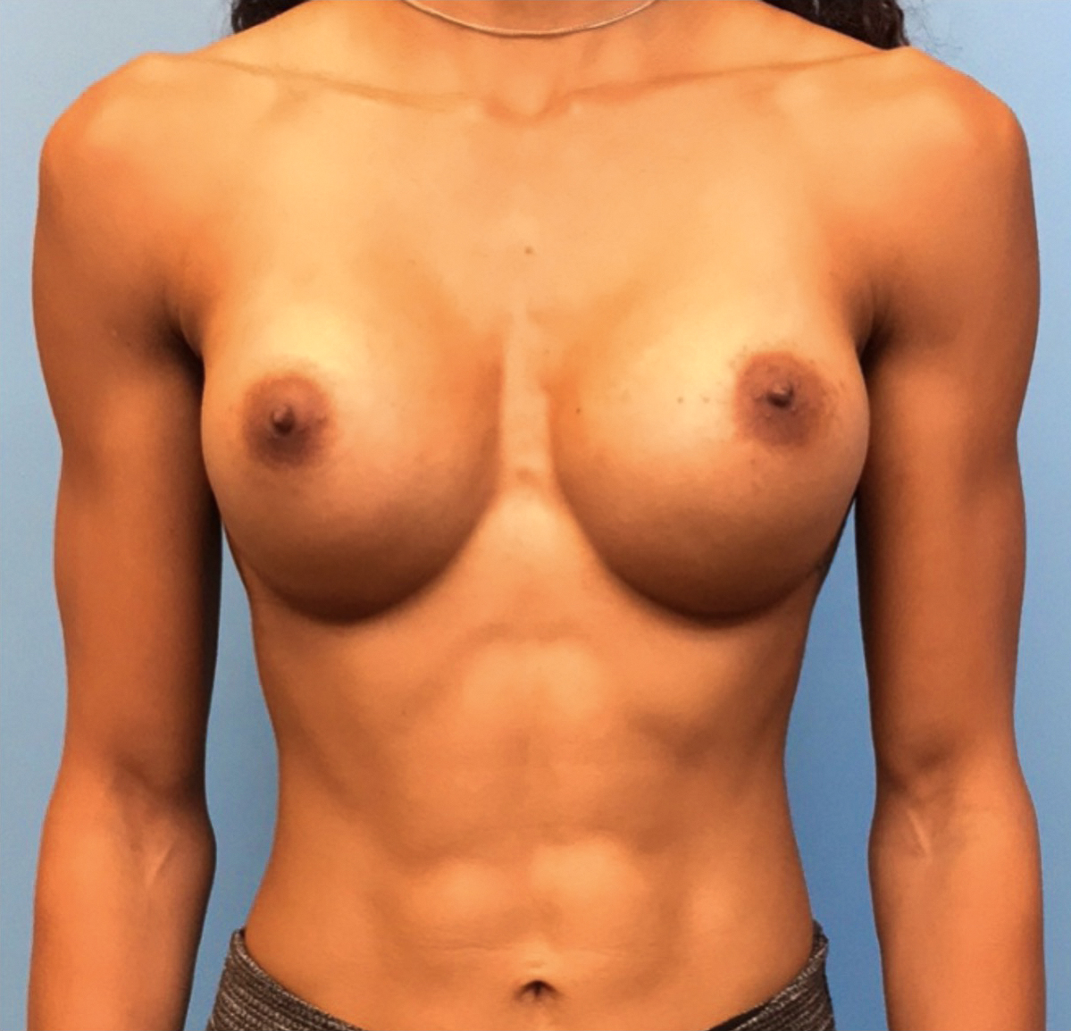 Breast-Augmentation-Case--221 | After Breast Augmentation 1