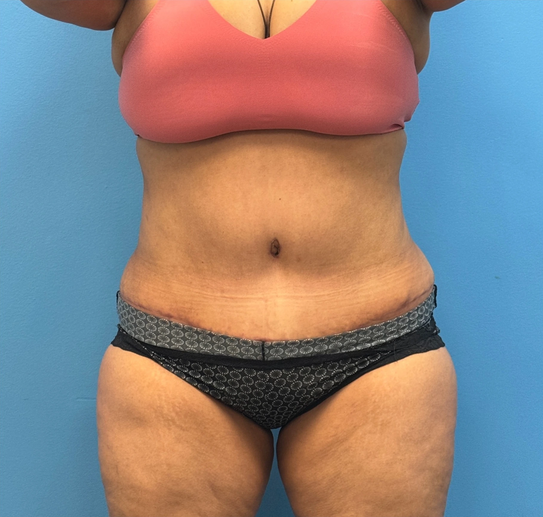 Lipoabdominoplasty-Case--27602 | After Liposuction 1