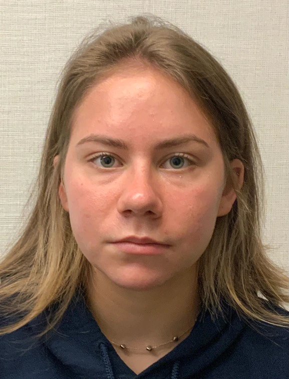 Rhinoplasty-Septoplasty-Case--23611 | After Rhinoplasty 3