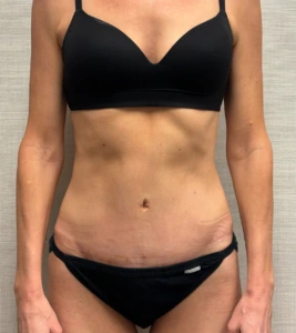 Revision-Tummy-Tuck-Case--23643 | After Tummy Tuck 1