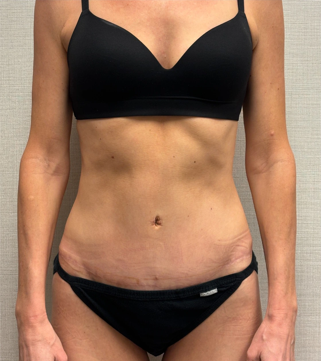 Revision-Tummy-Tuck-Case--23643 | After Tummy Tuck 1