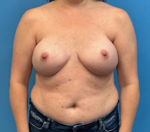Breast-Reconstruction-Case--27065 | After Breast Reconstruction 1