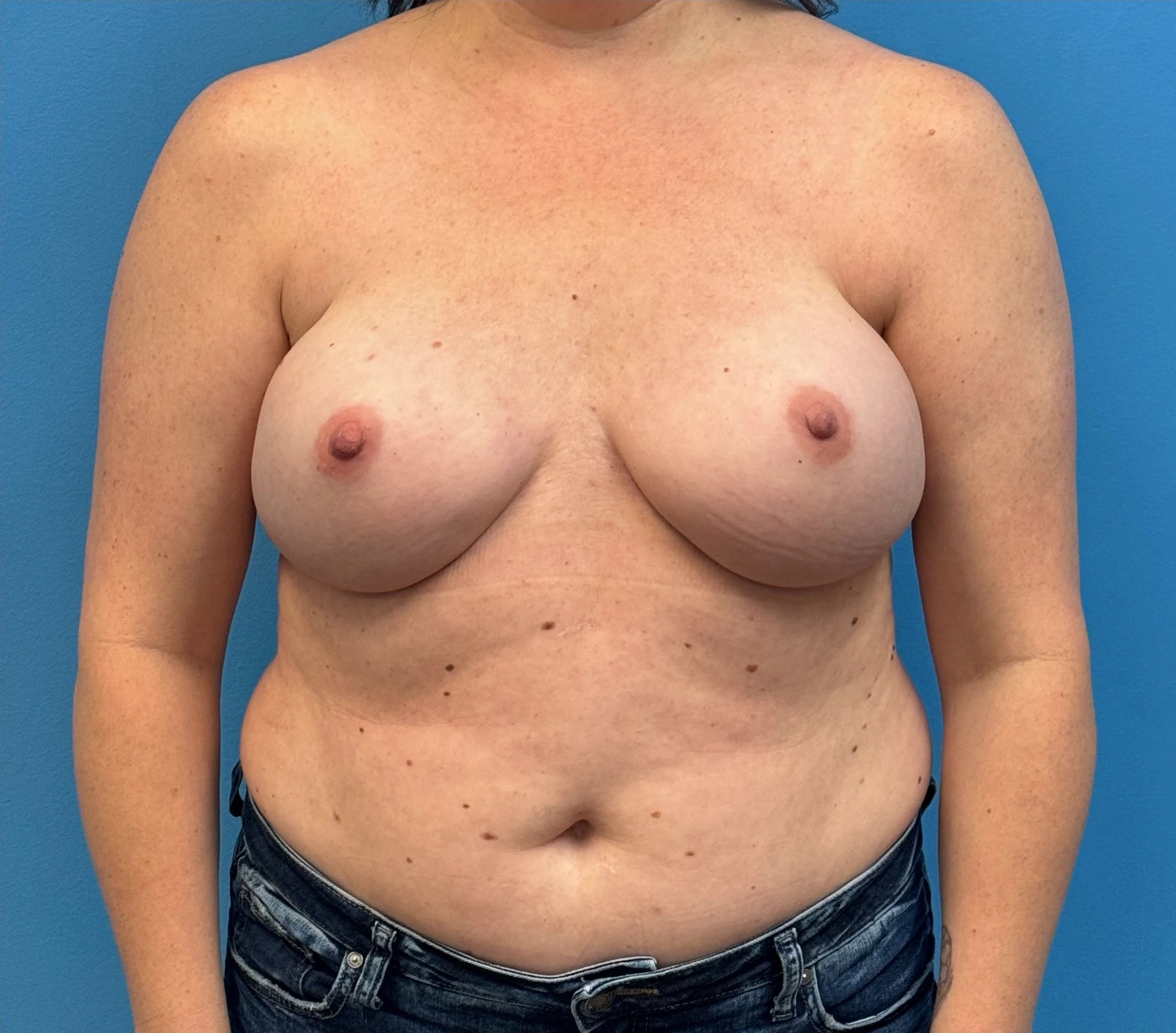 Breast-Reconstruction-Case--27065 | After Breast Reconstruction 1