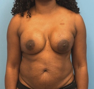 Breast-Reconstruction-Case--23930 | After Breast Reconstruction 1