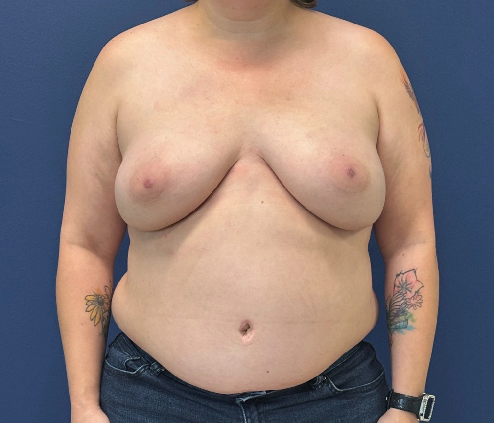 DIEP-Flap-Case--28021 | After DIEP Flap 1