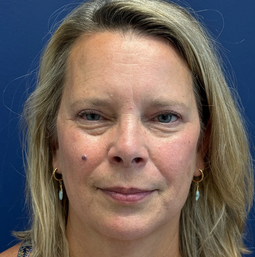 Blepharoplasty-Case--13622 | After Eyelid Surgery 1