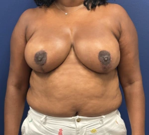 Breast-Reduction-Case--28242 | After Breast Reduction 1