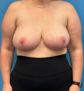 Breast-Reduction-Case--28338 | After Dr. Samir Rao 1