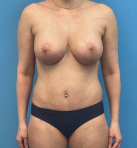 Breast-Augmentation-Tummy-Tuck-Case--28080 | After Body Lift 1