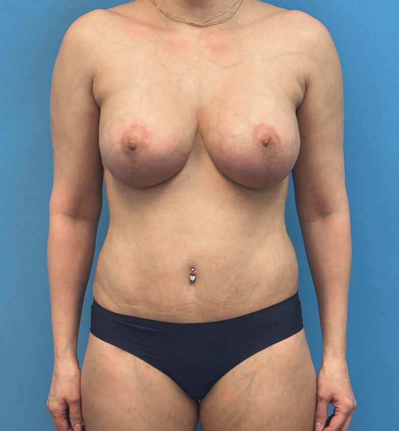 Breast-Augmentation-Tummy-Tuck-Case--28080 | After Body Lift 1