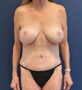 Lipoabdominoplasty-Case--27935 | After Liposuction 1