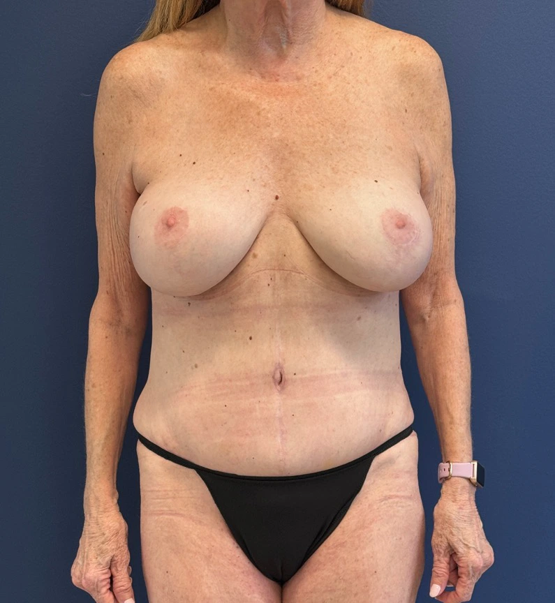 Lipoabdominoplasty-Case--27935 | After Liposuction 1