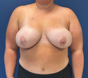 DIEP-Flap-Case--27595 | After DIEP Flap 1