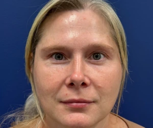 Blepharoplasty-Case--29601 | After Eyelid Surgery 1