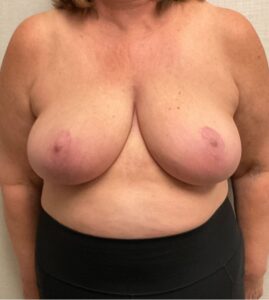 Breast-Reduction-Case--26425 | After Breast Reduction 1