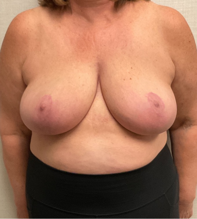 Breast-Reduction-Case--26425 | After Breast Reduction 1