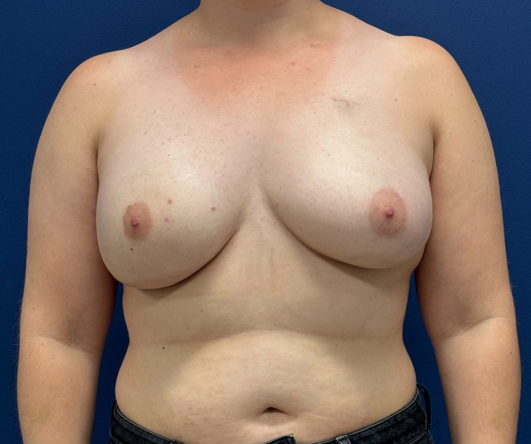 Breast-Reconstruction-Case--28689 | After Breast Reconstruction 1