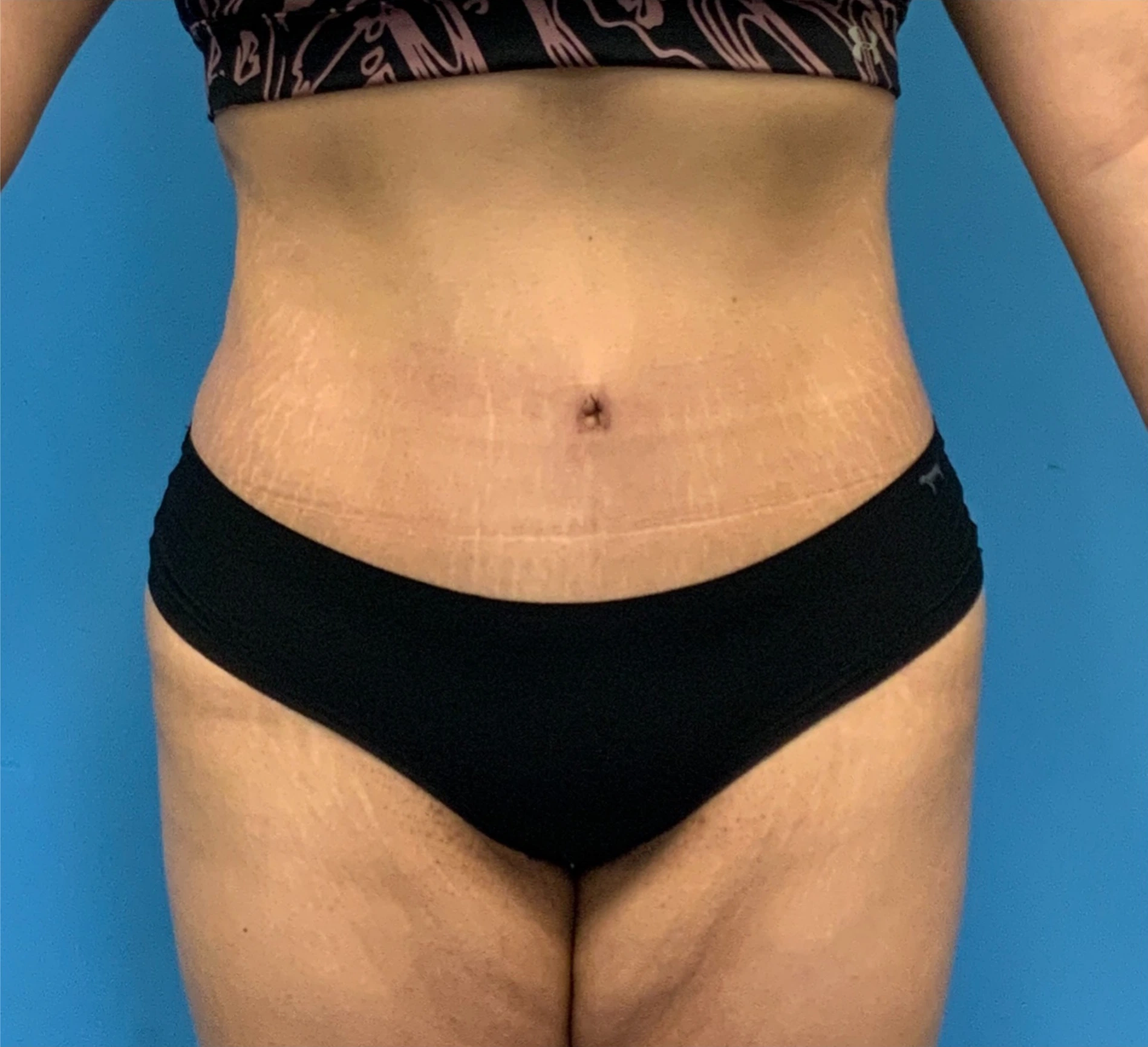Abdominoplasty-Case--23747 | After Tummy Tuck 1