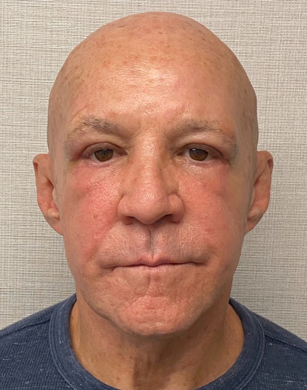 Blepharoplasty-Case--24169 | After Eyelid Surgery 2