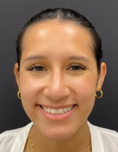 Rhinoplasty-Case--376 | After Rhinoplasty 1