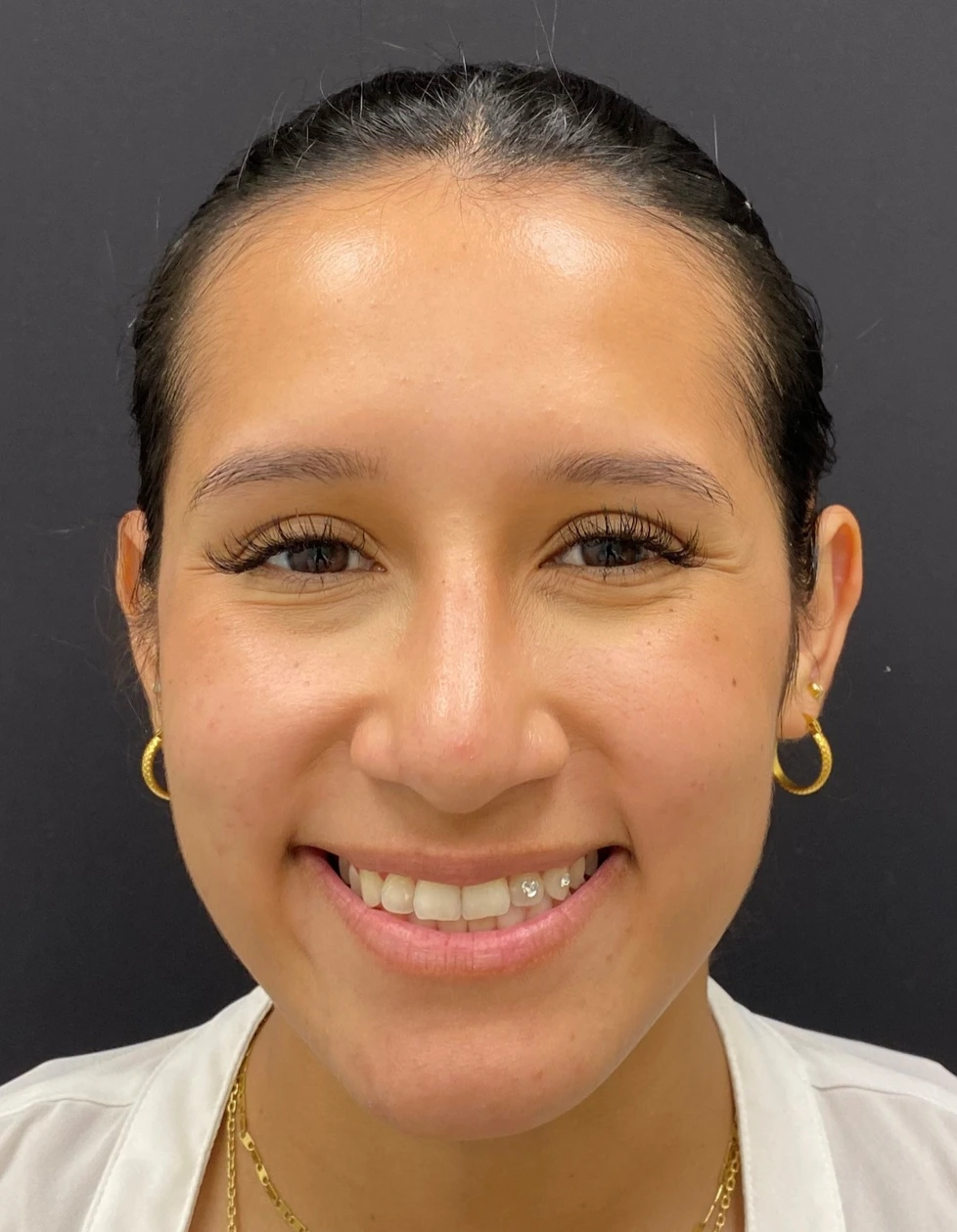 Rhinoplasty-Case--376 | After Rhinoplasty 1