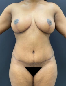 Mommy-makeover-Case--336 | After Mommy Makeover 1