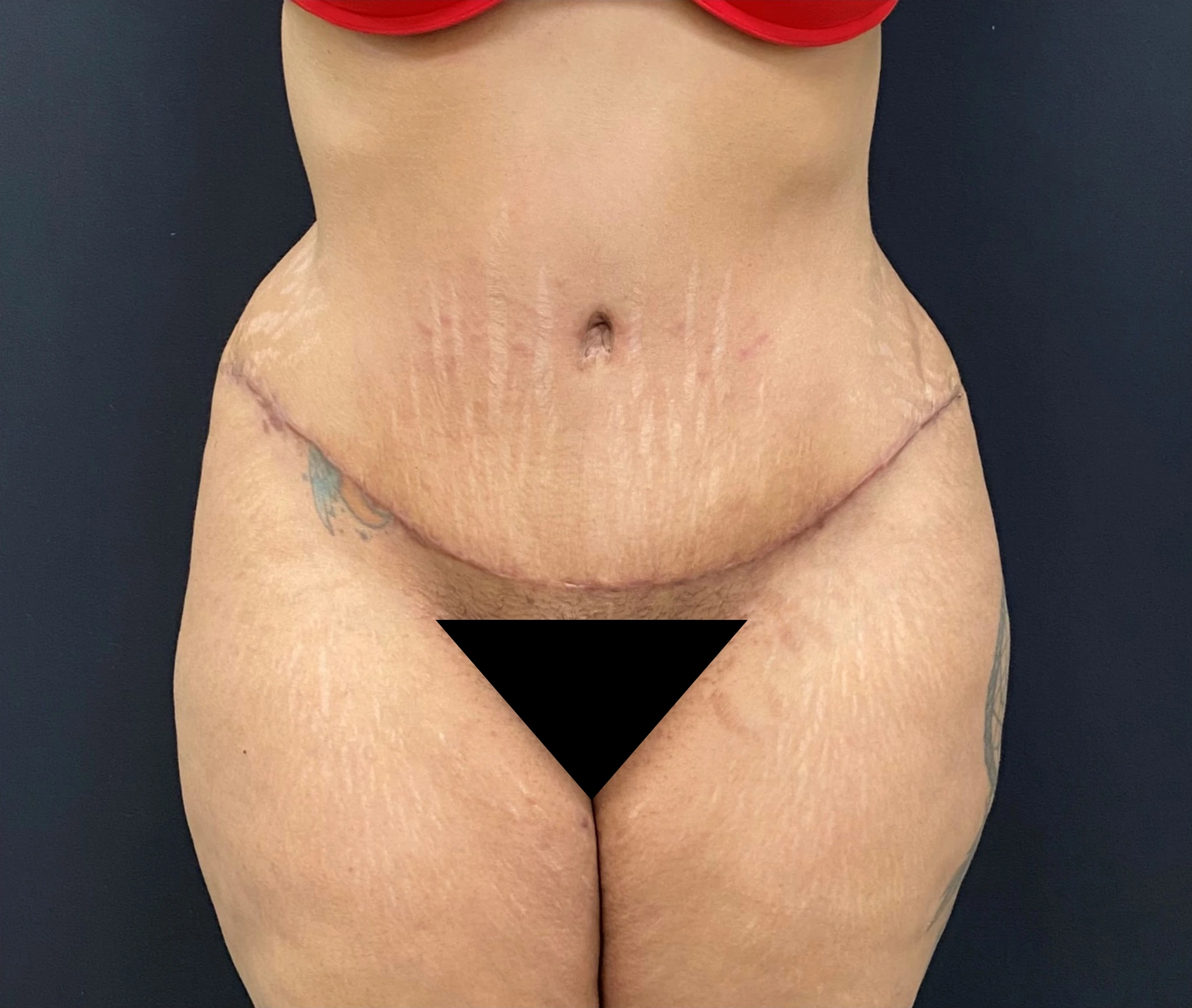 Liposuction-Tummy-Tuck-Case--338 | After Liposuction 1